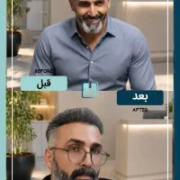 کاشت مو و ابرو