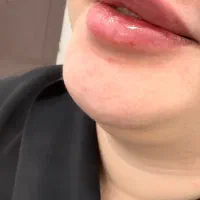 تزریقات زیبایی و هایفو ۱۲ بعدی