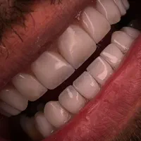 کامپوزیت دندان نانو سرامیک/عصب کشی/ایمپلنت اقساط