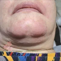 الکترولیز موی زائد سفید ومشکی