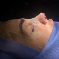 رینوپلاستی ۲۵میلیون