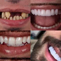 کامپوزیت زیبایی و لمینت دندان(جرمگیری رایگان)|خدمات آرایشگری و زیبایی|شیراز, هفت تنان|دیوار