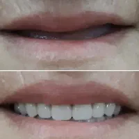 ساخت دندان مصنوعی طبیعی واقتصادی توسط پروتزیست|خدمات زیبایی و سلامت|کرج, گلشهر|دیوار