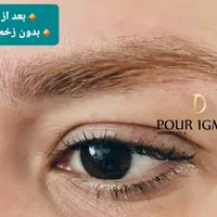 ریموو ابرو چشم لب آنزیم تراپی نانوبروز مدل آموزش|خدمات آرایشگری و زیبایی|تهران, امیرآباد|دیوار