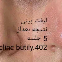 لیزرمیکرو پلاسمالیفت زیبایی/ بینی شیک/بلفاروپلاستی|خدمات آرایشگری و زیبایی|کرمانشاه, |دیوار