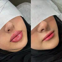 تزریق ژل بوتاکس