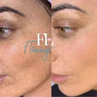 فیشالدرمطب/درمانجوشوخشکی آراف|خدمات آرایشگری و زیبایی|قم, دورشهر|دیوار