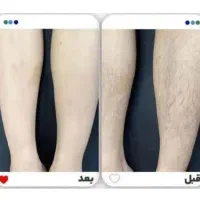 آموزش مرکز لیزر مو طول موج کندلا لیزر بانوان لیزر|خدمات آموزشی|اصفهان, خواجو|دیوار