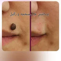 درمان خال،میخچه و زگیل