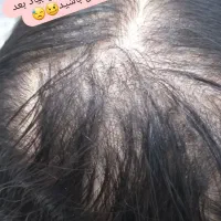 پاکسازی کف سر،درمان ریزش،شوره چربی سروضخیم سازی مو|خدمات آرایشگری و زیبایی|نیشابور, هفده شهریور|دیوار