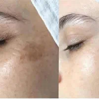 آموزش وخدمات فیشال،پی آرپی،مزوتراپی، مزونیدیلینگ|خدمات آرایشگری و زیبایی|کرج, گوهردشت|دیوار