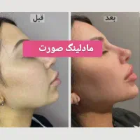 بوتاکس،فیلر،مادلینگ صورت،انواع جوانساز