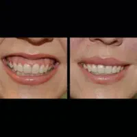 بوتاکس فقط ۹۵۰ ( پیشانی لبخند لثه ای زیر بغل و..)|خدمات آرایشگری و زیبایی|محمدیه-قزوین, |دیوار