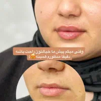 تزریق ژل و بوتاکس و فیشال تخصصی توسط پزشک|خدمات آرایشگری و زیبایی|برازجان, |دیوار