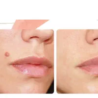 برداشت خال میخچه منگوله گوشتی بدون درد و خونریزی