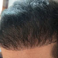 کاشت مو و ابرو با تخفیف ویژه فصل،بدون ریزش