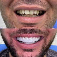 ایمپلنت.عصبکشی.دندان مصنوعی.روکش.لمینت کامپوزیت