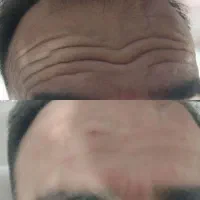 تخفیف ویژه ی عیدژل وبوتاکس۸۵۰(خانم هاوآقایان)