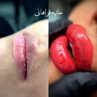 مرکز تخصصی شیدینگ لب رژ لب و درمان تیرگی لب