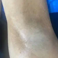 لیزر مو باتخفیف و ریزش ۹۹درصدی چهارصد