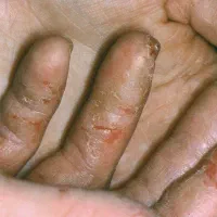 درمان پسوریازیس به صورت ریشه ای|آرایشی، بهداشتی، درمانی|جیرفت, |دیوار