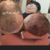 میخوای تضمینی باهزینه کمتر درشهر خودت کاشت مو کنی|خدمات آرایشگری و زیبایی|یزد, |دیوار