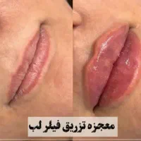 ژل لب.چانه.خط خنده هرسی سی۱تومن