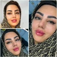 prp پی ارپی ژل فیلر بوتاکس نخ لیزر فیشیال هایفو|خدمات آرایشگری و زیبایی|مشهد, هفت تیر (حافظ)|دیوار