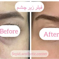 بوتاکس‌ ژل فیلر مزو خالبرداری‌ کرایو‌ وهایفو ولیزر|خدمات آرایشگری و زیبایی|تبریز, |دیوار
