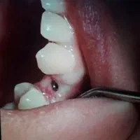 کاشت دندان(ایمپلنت)بدون جراحی.برش.بخیه
