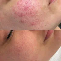 رفع جای جوش/تیرگی صورت/لایه بردار صورت
