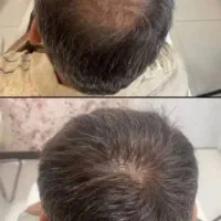 تونیک تقویت و ضدریزش مو
