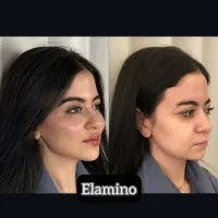 تزریق ژل بوتاکس فیلر در کلینیک زیبایی تهران|خدمات آرایشگری و زیبایی|تهران, یافت آباد جنوبی|دیوار