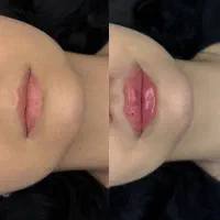 تزریق فیلر لب روسی