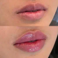 تزریق ژل لب و صورت با توجه به تناسب چهره