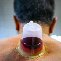 حجامت حرفه ای کلینیک