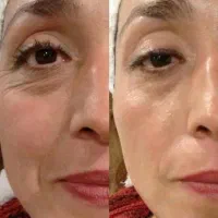 هایفوتراپی در مطب پزشک با قیمتی باورنکردنی