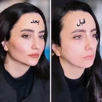 نیازمند مدل بوتاکس و ژل.اموزش ژل و بوتاکس|خدمات آرایشگری و زیبایی|صدرا-فارس, فاز ۱|دیوار