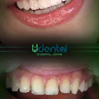 کامپوزیت، لمینت، ایمپلنت اقساط ویژه|خدمات آرایشگری و زیبایی|تاکستان, |دیوار