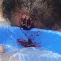 انوع فصد و حجامت های تخصصی
