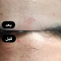 جشنواره زیبایی پوست با هایفوتراپی و آر اف فرکشنال|خدمات آرایشگری و زیبایی|قم, دورشهر|دیوار