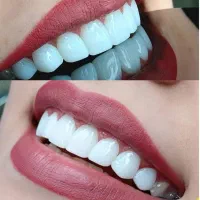 کامپوزیت دندان، روکش، دندانپزشکی تخصصی تهرانسر|خدمات آرایشگری و زیبایی|تهران, تهرانسر مرکزی|دیوار
