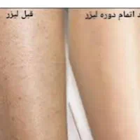 لیزر ژل بوتاکس موژان