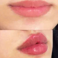 تزریق ژل و بوتاکس، نخ، مزو، فیلربادی