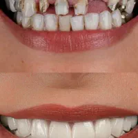 دندانپزشکی اقساطی بدون پیش پرداخت ایمپلنت کامپوزیت|خدمات آرایشگری و زیبایی|خرم‌آباد, |دیوار