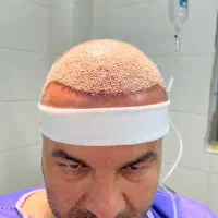 جشنواره کاشت مو ، ابرو ریش|خدمات زیبایی و سلامت|شیراز, قصرالدشت|دیوار