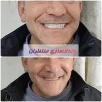 دندان مصنوعی/ ضمانتی / ایتالیایی/ جوان پسند|خدمات آرایشگری و زیبایی|مشهد, امام رضا (ع)|دیوار
