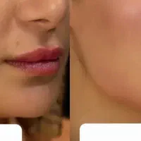 جذب مدل ژل صورت مخصوص فرمدهی و جوانسازی|خدمات آرایشگری و زیبایی|اندیمشک, |دیوار