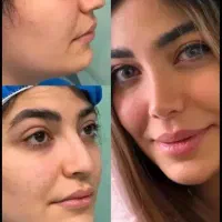 عمل جراحی بینی با مشاوره رایگان وطراحی چهره کرج