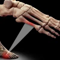 کارپراکتیک تنگی نخاعی،دیسک،در رفتگی استخوان مطب